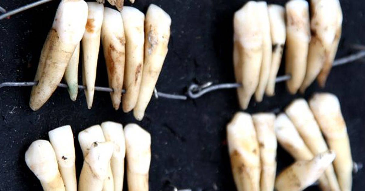 That time dentures were made from dead soldiers’ teeth